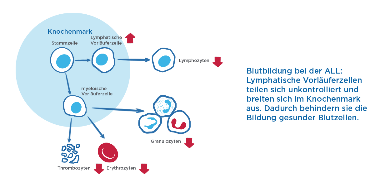 Stammzellen im Knochenmark teilen sich in lymphatische oder myeloische Vorläuferzellen. Die myeloischen Vorläuferzellen entwickeln sich außerhalb des Knochenmarks weiter zu Granulozyten, Erythrozyten oder Thrombozyten. Die lymphatischen Vorläuferzellen entwickeln sich außerhalb des Knochenmarks weiter zu Lymphozyten. Wenn diese entartet sind, wird die Entwicklung der Lymphozyten und damit des Blutsystems gestört.