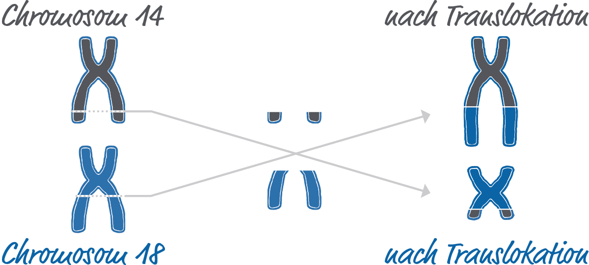 Illustration von Chromosom 14 in grau und Chromosom 18 in blau, welche jeweils einen Teil verlieren. Nach falscher Zusammensetzung, als Translokation beschriftet, tragen beide Chromosomen jeweils ein Stück des anderen Chromosoms